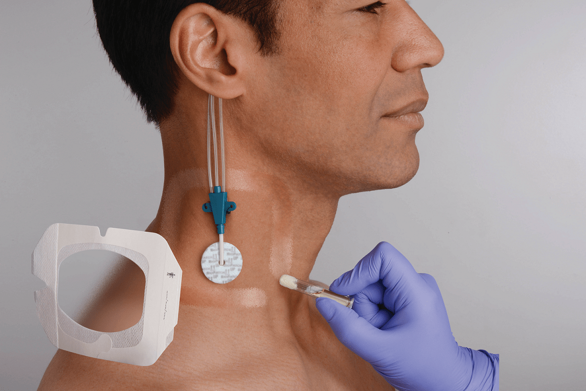 Mastisol Vascular Catheter Application.
